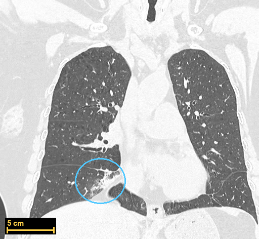 Opacidad en corte coronal